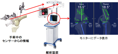 写真　手術中のセンサーからの情報　解析装置　モニターにデータ表示