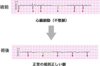 イメージ　メイズ手術前後の心臓細動（不整脈）発生頻度の比較