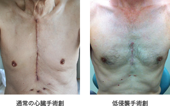 写真　通常の手術と低侵襲手術の創部の比較