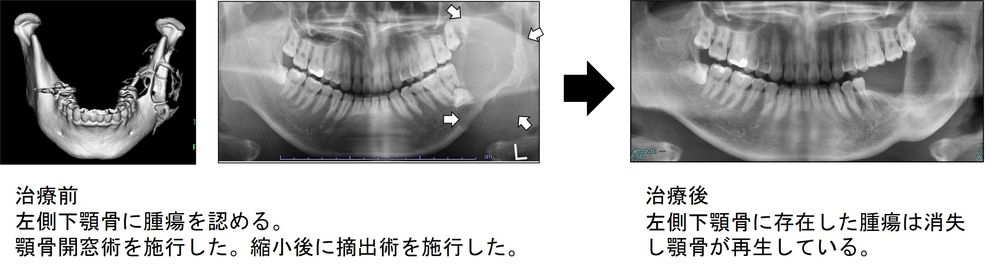 写真　顎骨嚢胞、顎骨腫瘍について