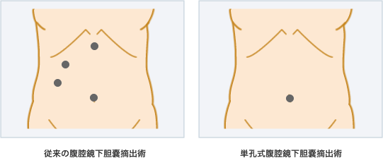 イメージ 左：従来の腹腔鏡下胆嚢摘出術、右：単孔式腹腔鏡下胆嚢摘出術