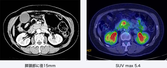 写真 左：膵頭部に径15mm　右：SUV max 5.4