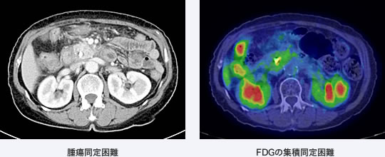 写真 左：腫瘍同定困難　右：FDGの集積同定困難