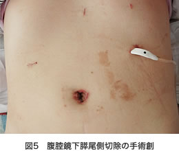 図5 腹腔鏡下膵尾側切除の手術創