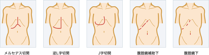図　左からメルセデス切開、逆L字切開、J字切開、腹腔鏡補助下、腹腔鏡下