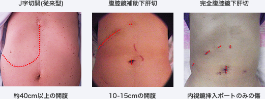 写真 左から J字切開（従来型）、腹腔鏡補助下肝切、完全腹腔鏡下肝切