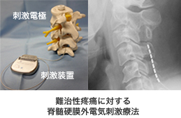 写真 難治性疼痛に対する脊髄硬膜外電気刺激療法