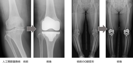 膝関節外科 整形外科 呉医療センター中国がんセンター 広島県呉市 病院