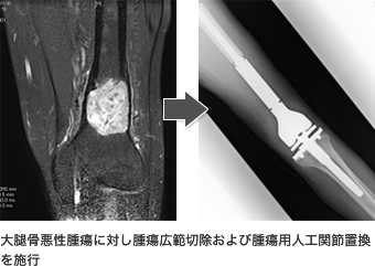 写真　大腿骨悪性腫瘍に対する腫瘍広範切除および腫瘍用人工関節置換
の施行の様子