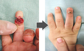 写真　薬指の血管吻合（再接着）手術の術前術後