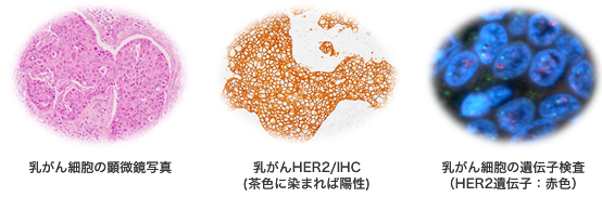 写真 乳がん細胞の顕微鏡写真と乳がんHER2/IHC(茶色に染まれば陽性)と乳がん細胞の遺伝子検査（HER2遺伝子：赤色）
