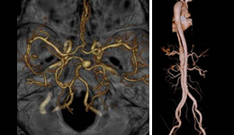 イメージ　CT血管検査の3D画像