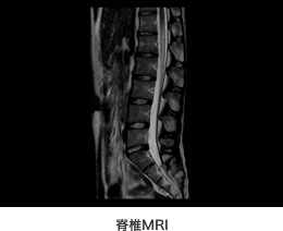 写真　脊椎MRI