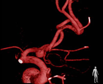 写真　血管撮影装置による血管3D画像