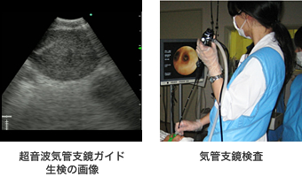 写真 超音波気管支鏡ガイド生検の画像、気管支鏡検査の様子